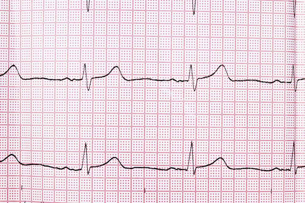 EKG für die HRV-Messung